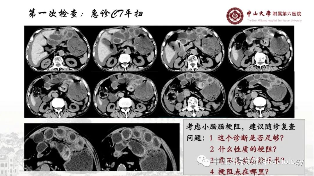 影像PPT - 【PPT】消化道急腹症的影像学诊断思路-29