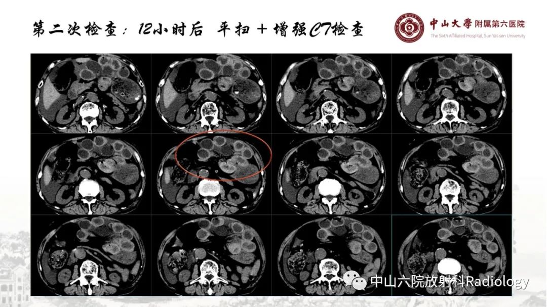影像PPT - 【PPT】消化道急腹症的影像学诊断思路-30