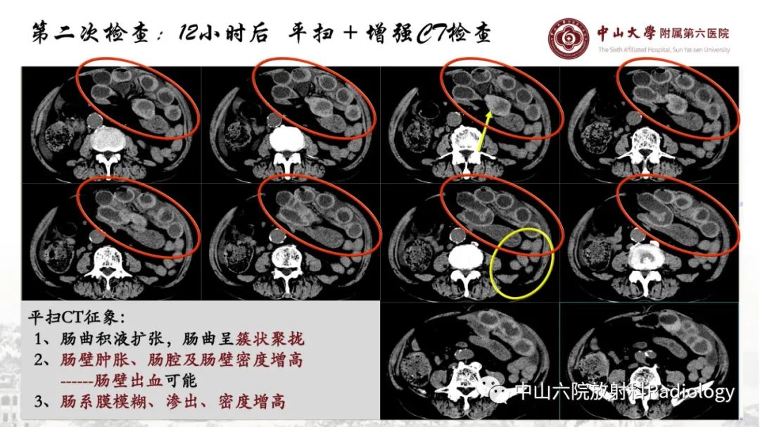 影像PPT - 【PPT】消化道急腹症的影像学诊断思路-31