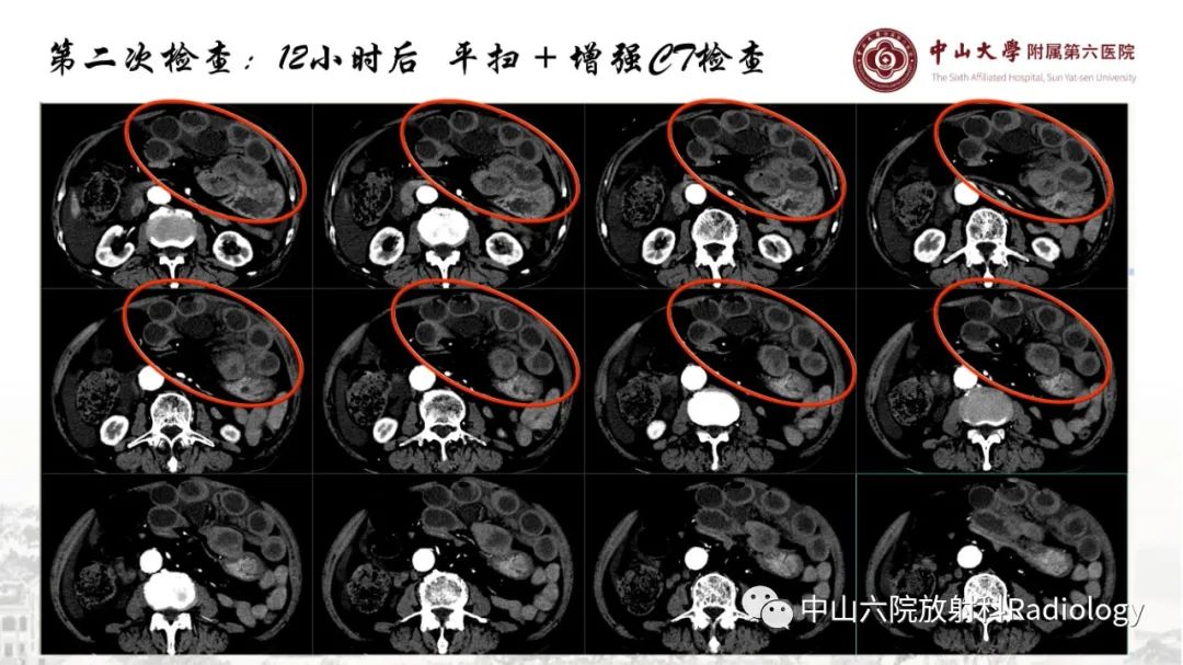 影像PPT - 【PPT】消化道急腹症的影像学诊断思路-32
