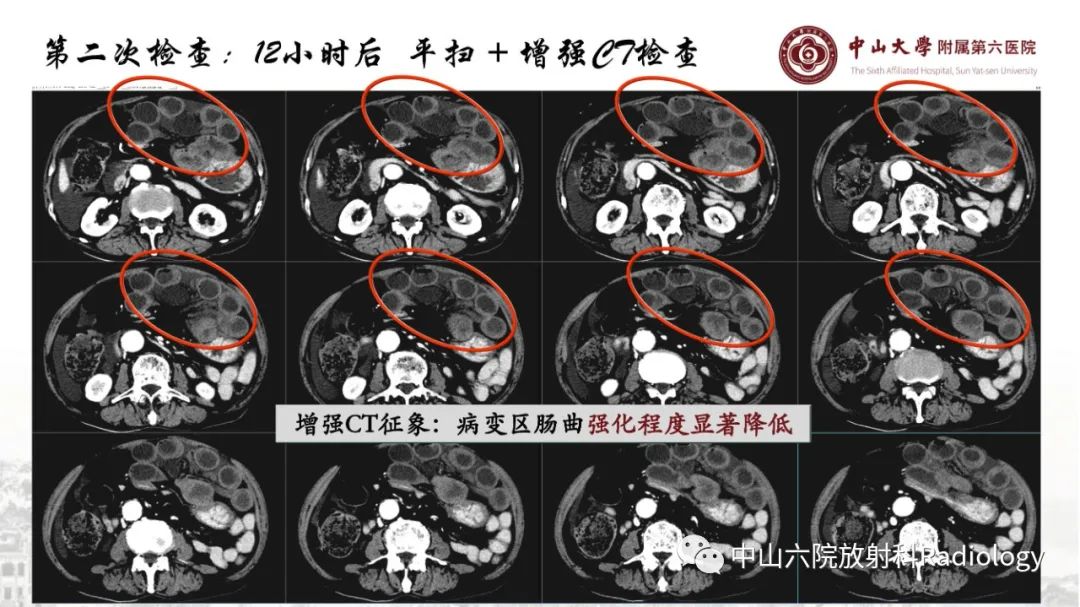 影像PPT - 【PPT】消化道急腹症的影像学诊断思路-33