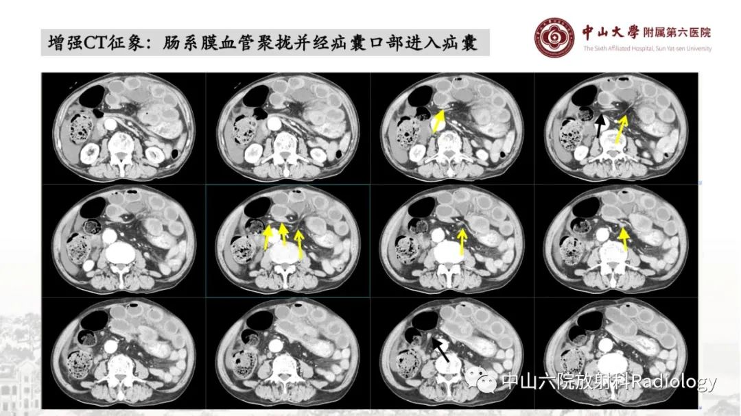 影像PPT - 【PPT】消化道急腹症的影像学诊断思路-34