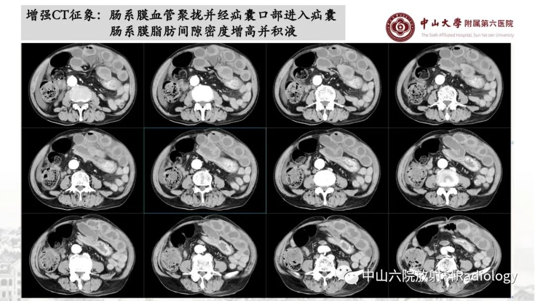 影像PPT - 【PPT】消化道急腹症的影像学诊断思路-35