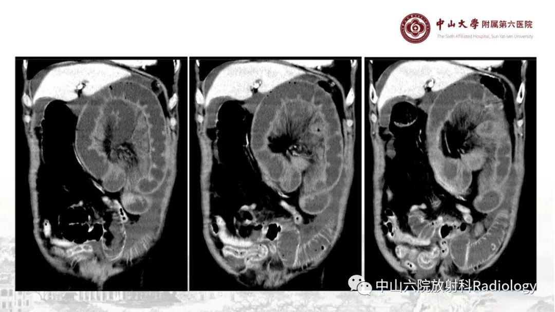 影像PPT - 【PPT】消化道急腹症的影像学诊断思路-37