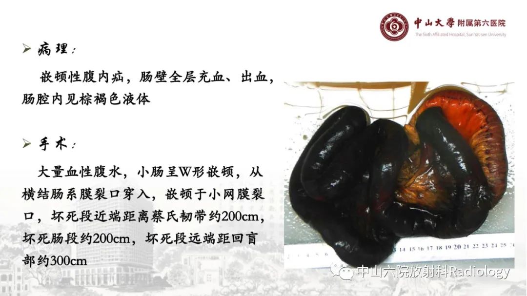 影像PPT - 【PPT】消化道急腹症的影像学诊断思路-38