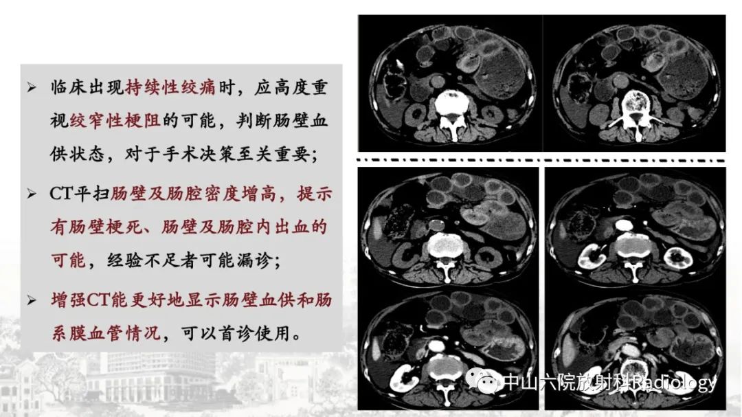 影像PPT - 【PPT】消化道急腹症的影像学诊断思路-39