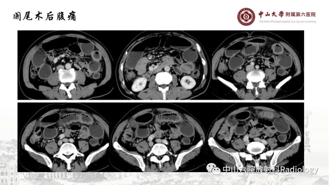 影像PPT - 【PPT】消化道急腹症的影像学诊断思路-42