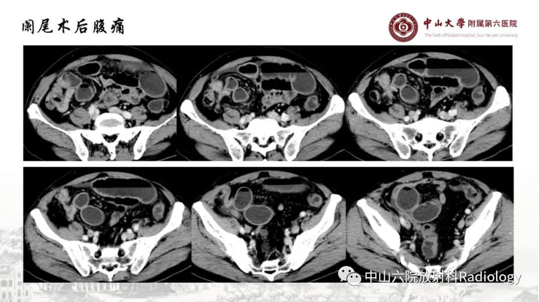 影像PPT - 【PPT】消化道急腹症的影像学诊断思路-43