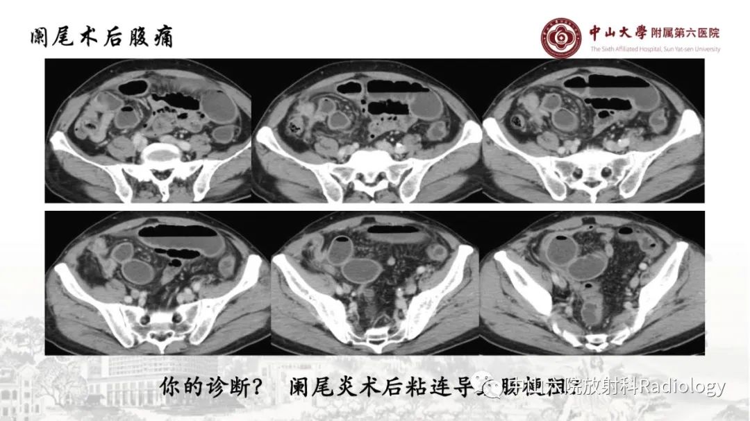 影像PPT - 【PPT】消化道急腹症的影像学诊断思路-44