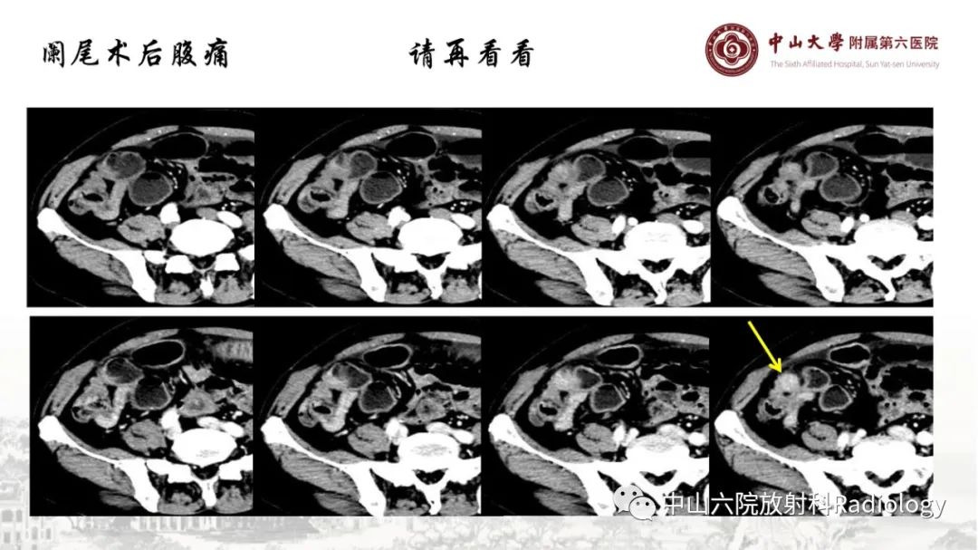 影像PPT - 【PPT】消化道急腹症的影像学诊断思路-45