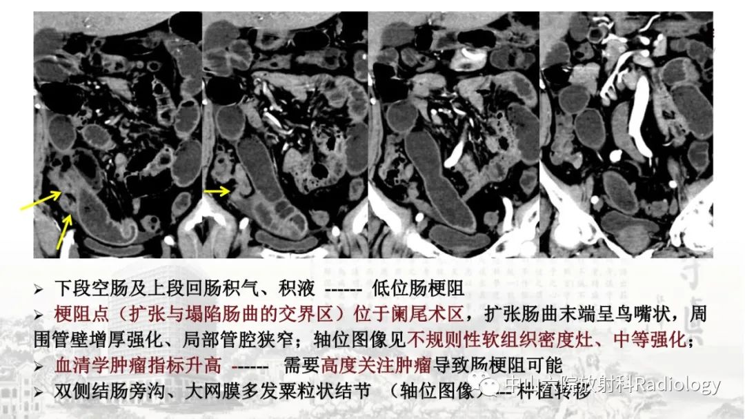 影像PPT - 【PPT】消化道急腹症的影像学诊断思路-47