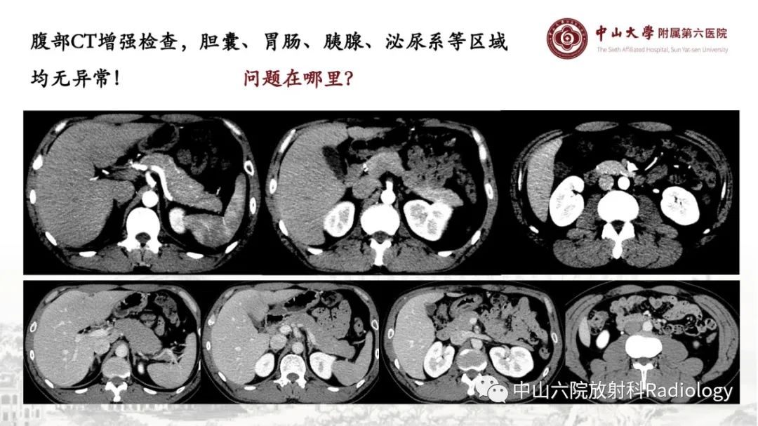 影像PPT - 【PPT】消化道急腹症的影像学诊断思路-50