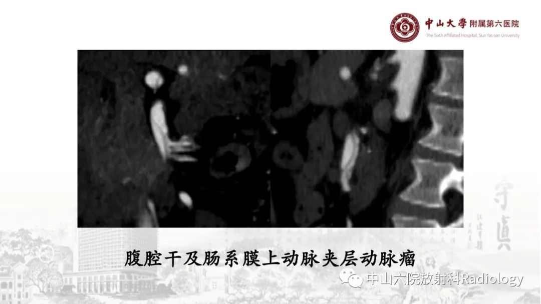 影像PPT - 【PPT】消化道急腹症的影像学诊断思路-52