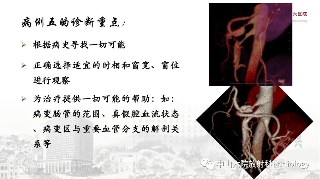 影像PPT - 【PPT】消化道急腹症的影像学诊断思路-53