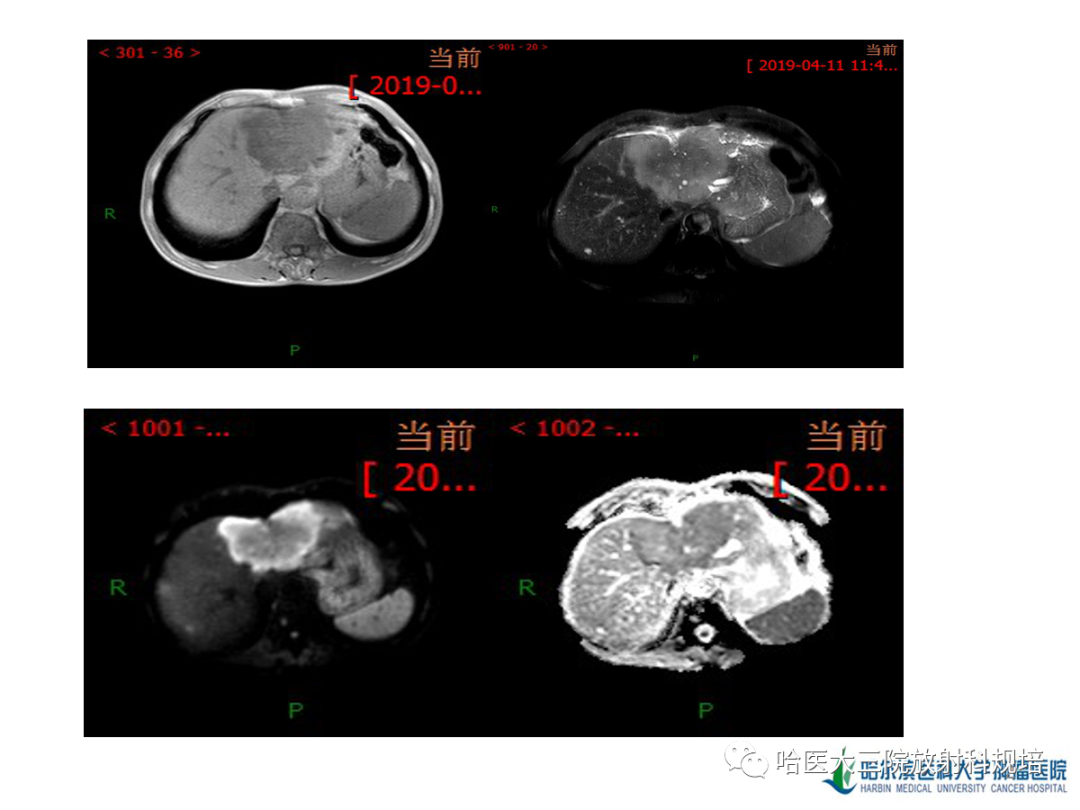 影像PPT - 【PPT】肝内胆管细胞癌-2