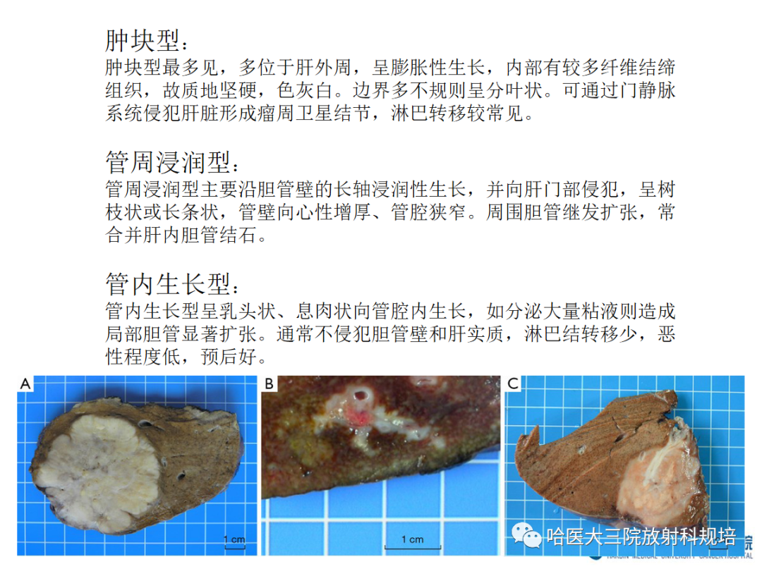 影像PPT - 【PPT】肝内胆管细胞癌-13
