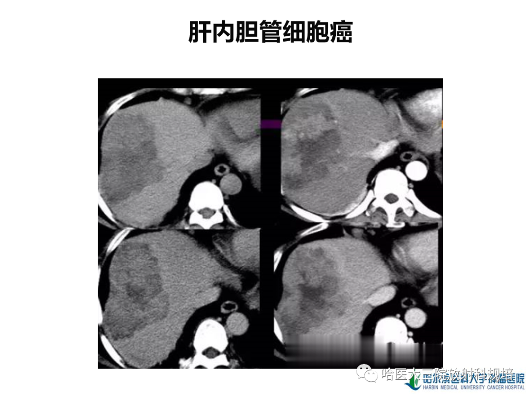 影像PPT - 【PPT】肝内胆管细胞癌-16