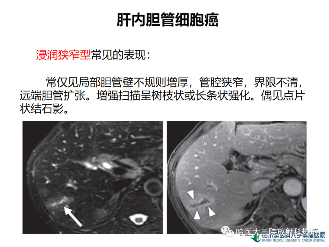 影像PPT - 【PPT】肝内胆管细胞癌-20