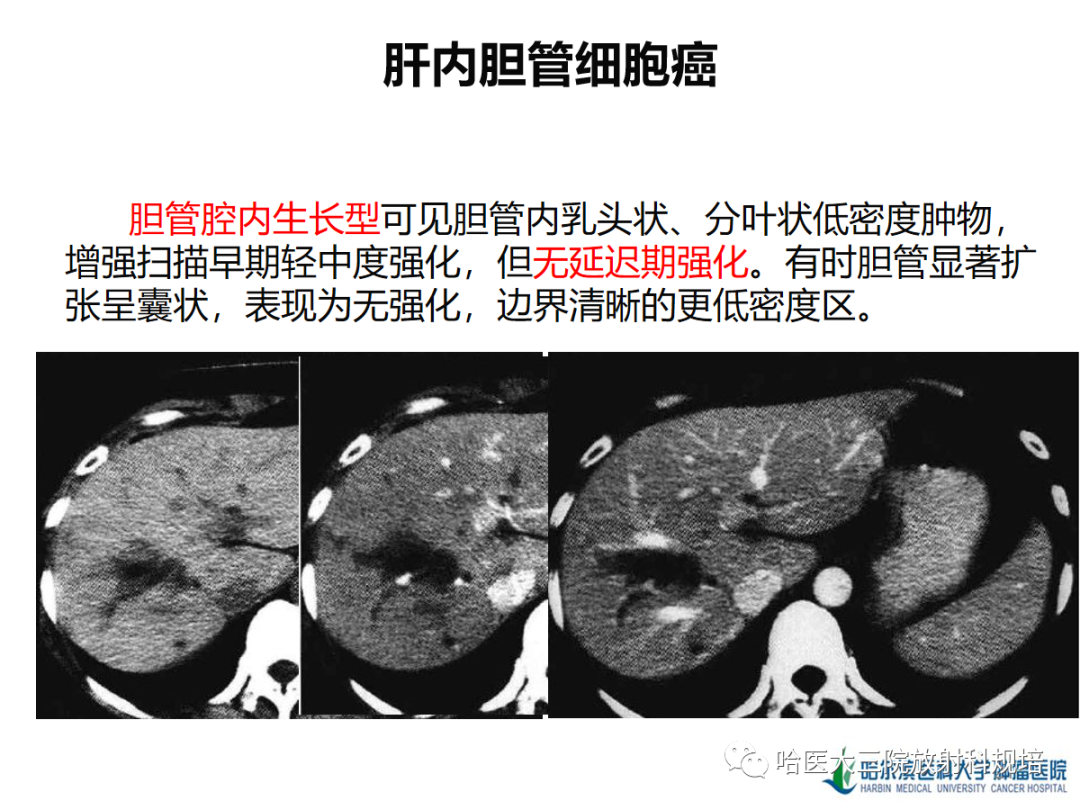 影像PPT - 【PPT】肝内胆管细胞癌-21