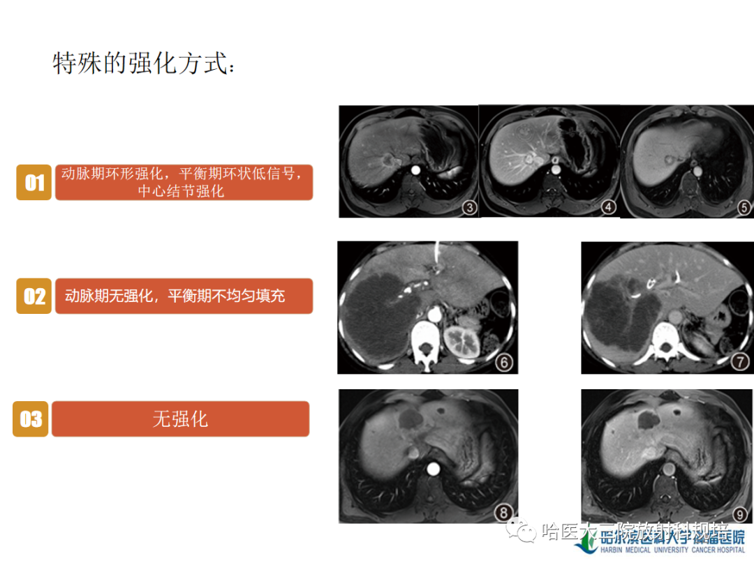 影像PPT - 【PPT】肝内胆管细胞癌-22