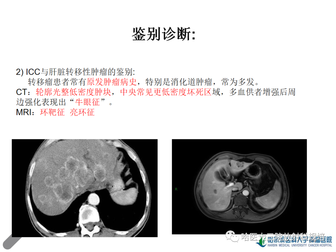 影像PPT - 【PPT】肝内胆管细胞癌-26