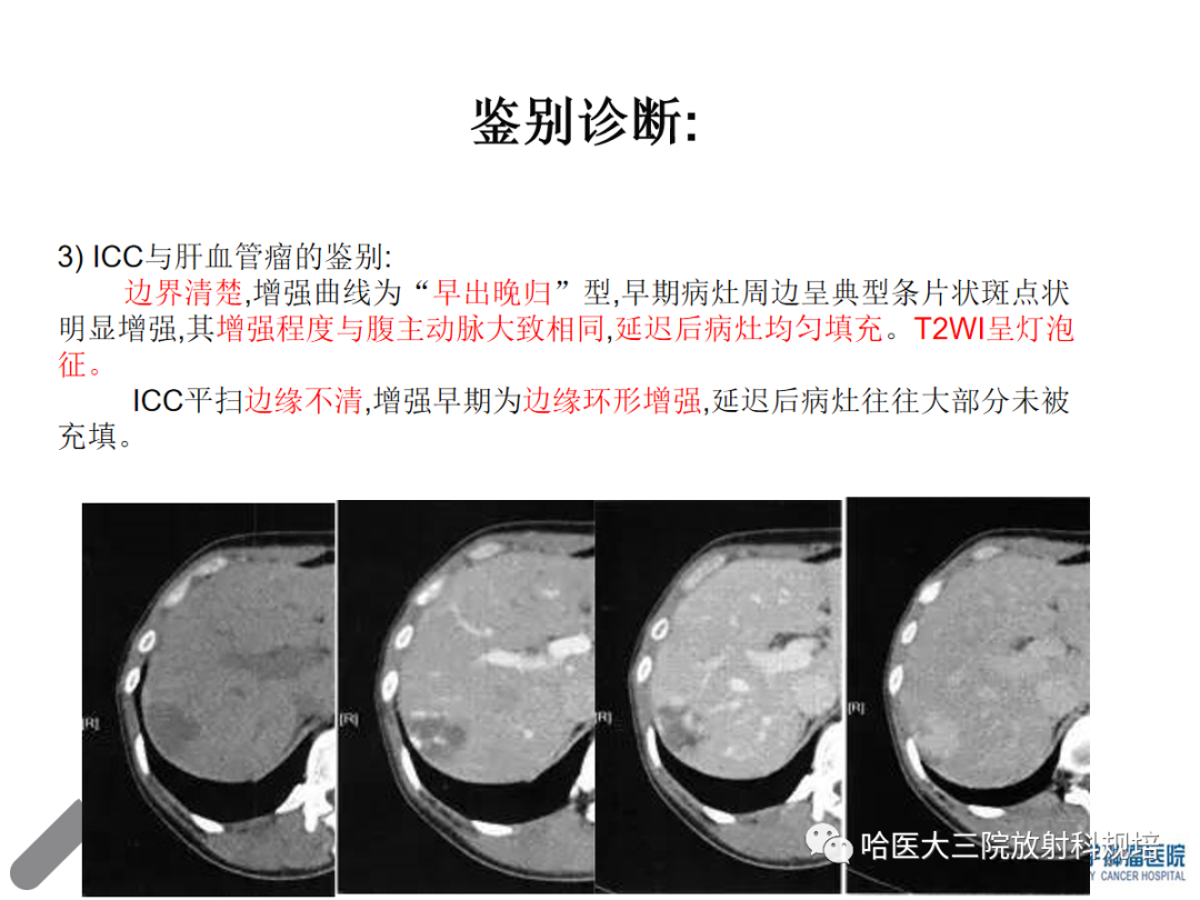 影像PPT - 【PPT】肝内胆管细胞癌-27