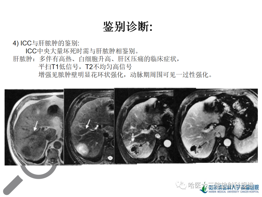 影像PPT - 【PPT】肝内胆管细胞癌-29