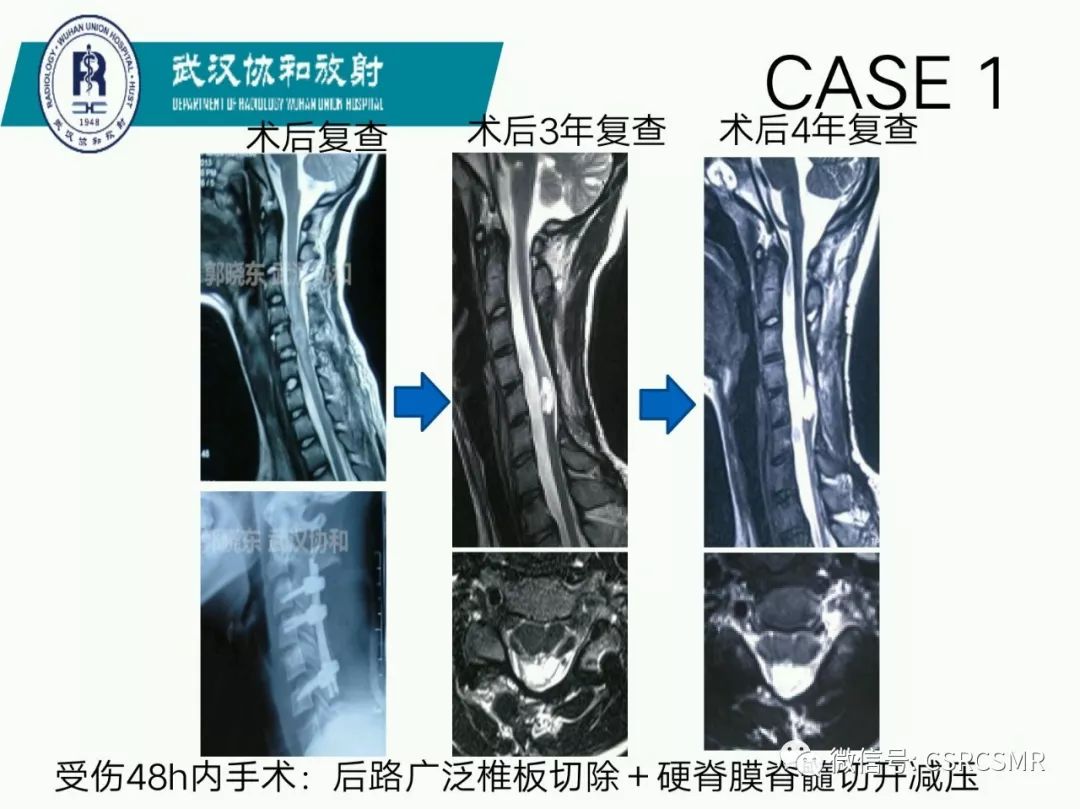 影像PPT - 【PPT】急性脊髓损伤--MR在临床决策和预后中的应用-4