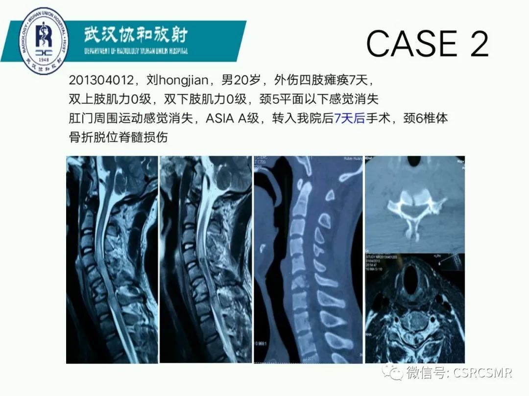 影像PPT - 【PPT】急性脊髓损伤--MR在临床决策和预后中的应用-7