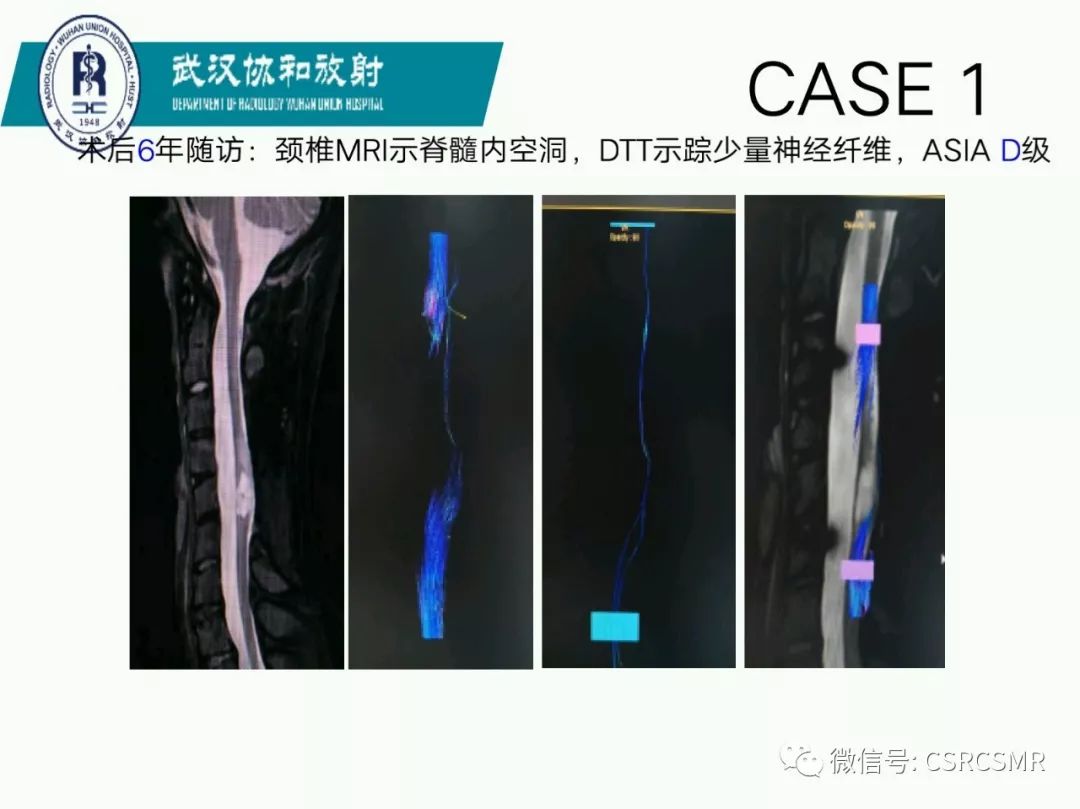 影像PPT - 【PPT】急性脊髓损伤--MR在临床决策和预后中的应用-6