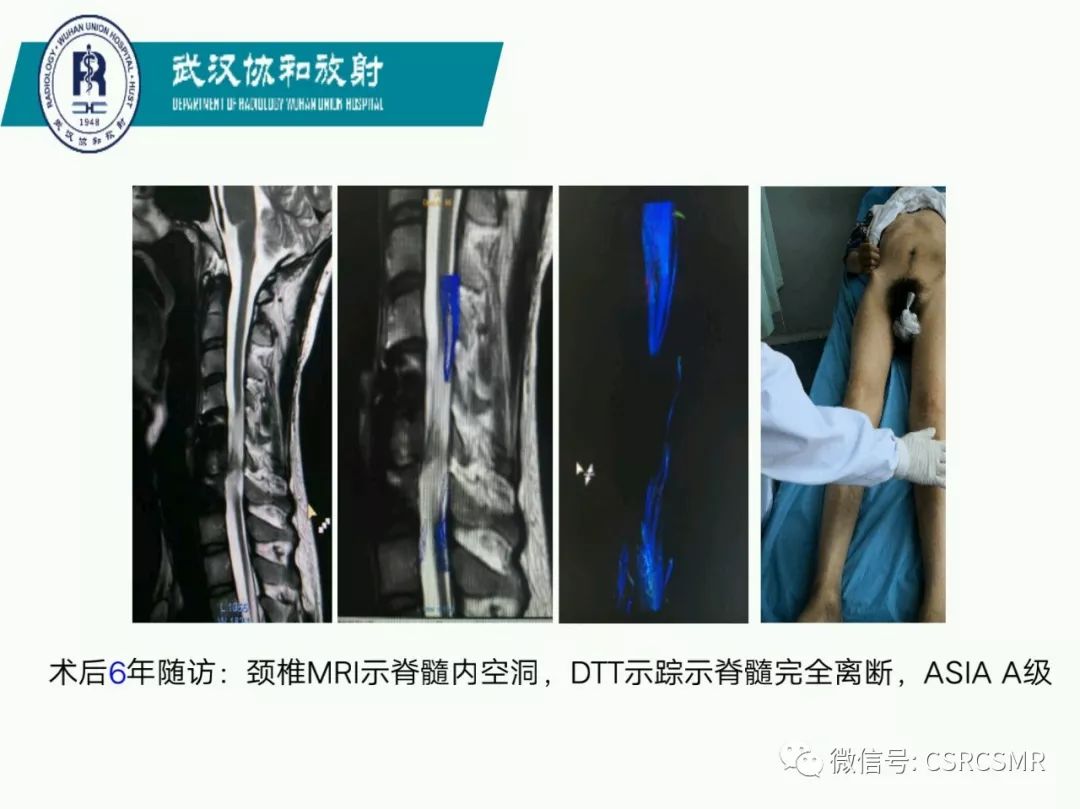 影像PPT - 【PPT】急性脊髓损伤--MR在临床决策和预后中的应用-8