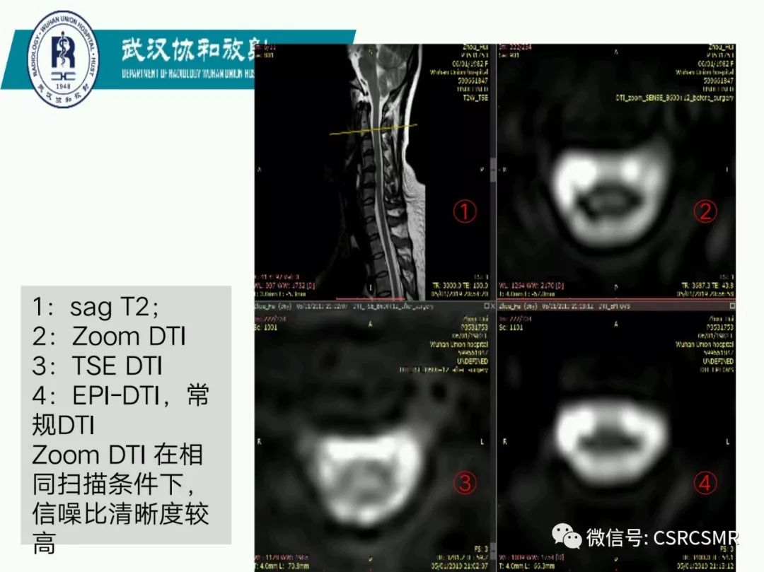 影像PPT - 【PPT】急性脊髓损伤--MR在临床决策和预后中的应用-14