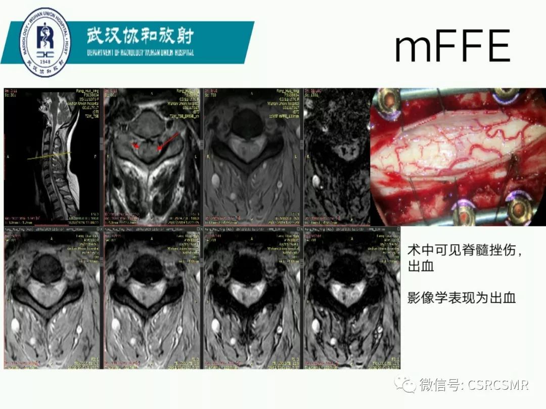 影像PPT - 【PPT】急性脊髓损伤--MR在临床决策和预后中的应用-16