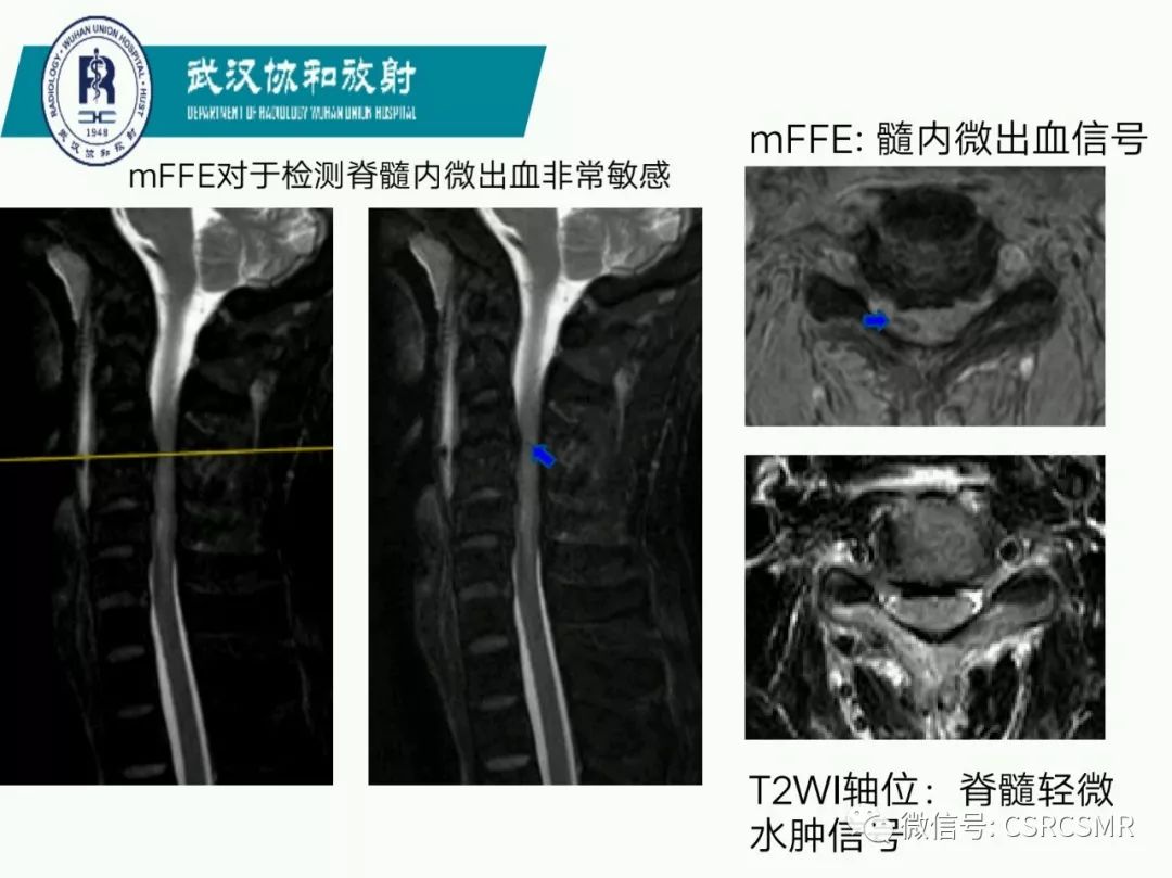 影像PPT - 【PPT】急性脊髓损伤--MR在临床决策和预后中的应用-17