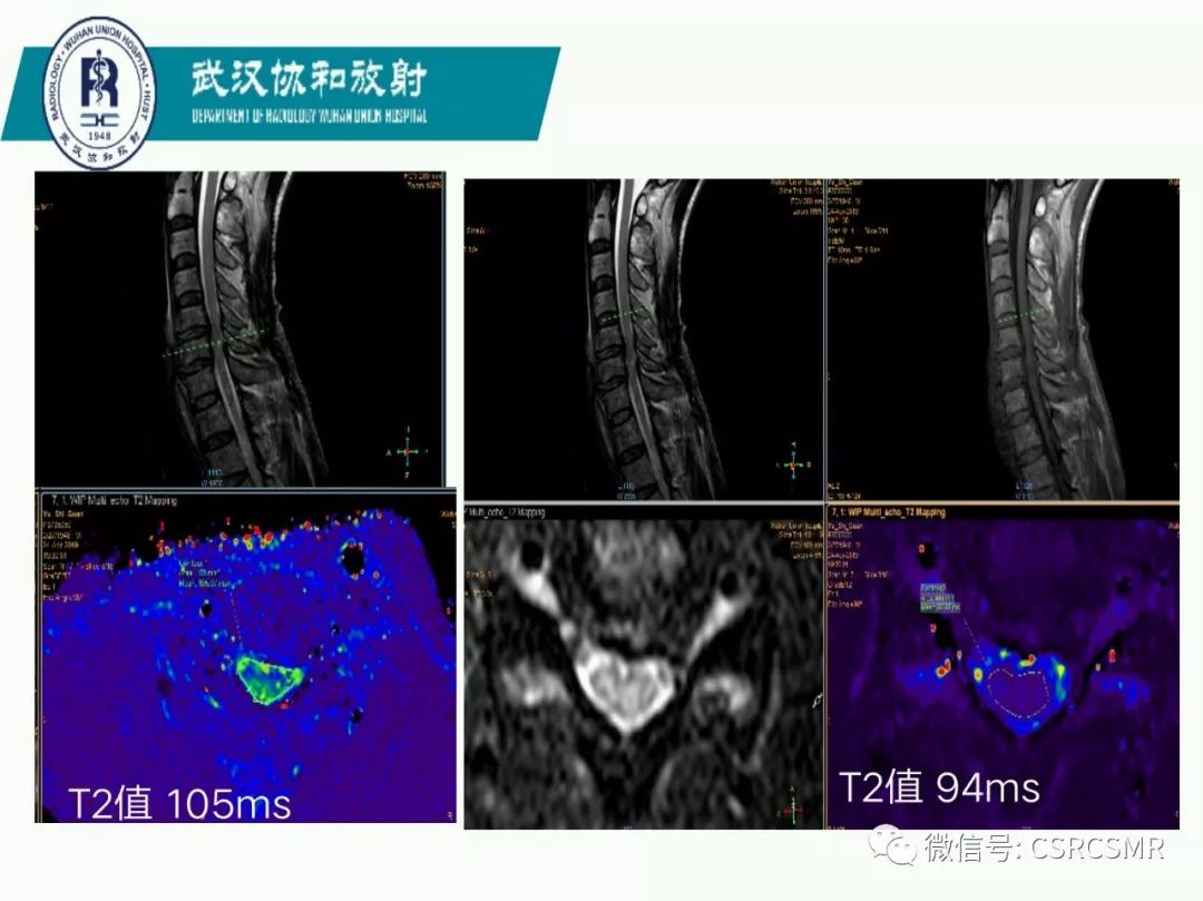 影像PPT - 【PPT】急性脊髓损伤--MR在临床决策和预后中的应用-19