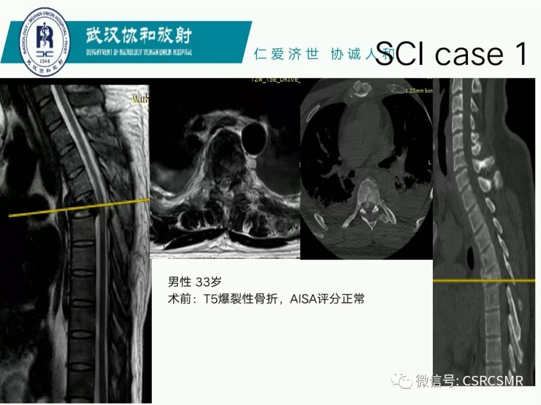 影像PPT - 【PPT】急性脊髓损伤--MR在临床决策和预后中的应用-21