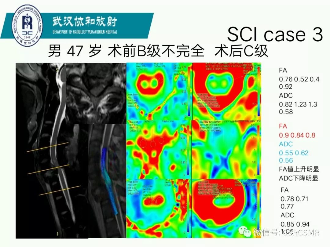 影像PPT - 【PPT】急性脊髓损伤--MR在临床决策和预后中的应用-24