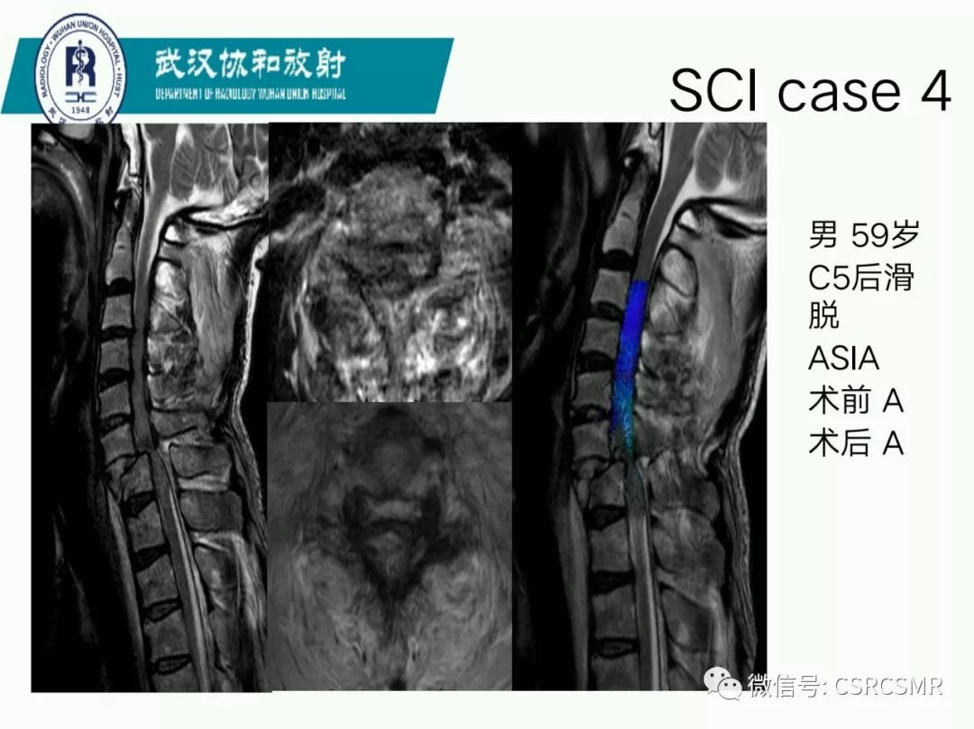 影像PPT - 【PPT】急性脊髓损伤--MR在临床决策和预后中的应用-25