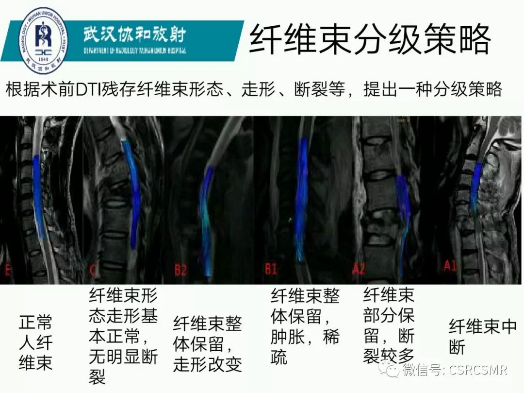 影像PPT - 【PPT】急性脊髓损伤--MR在临床决策和预后中的应用-27