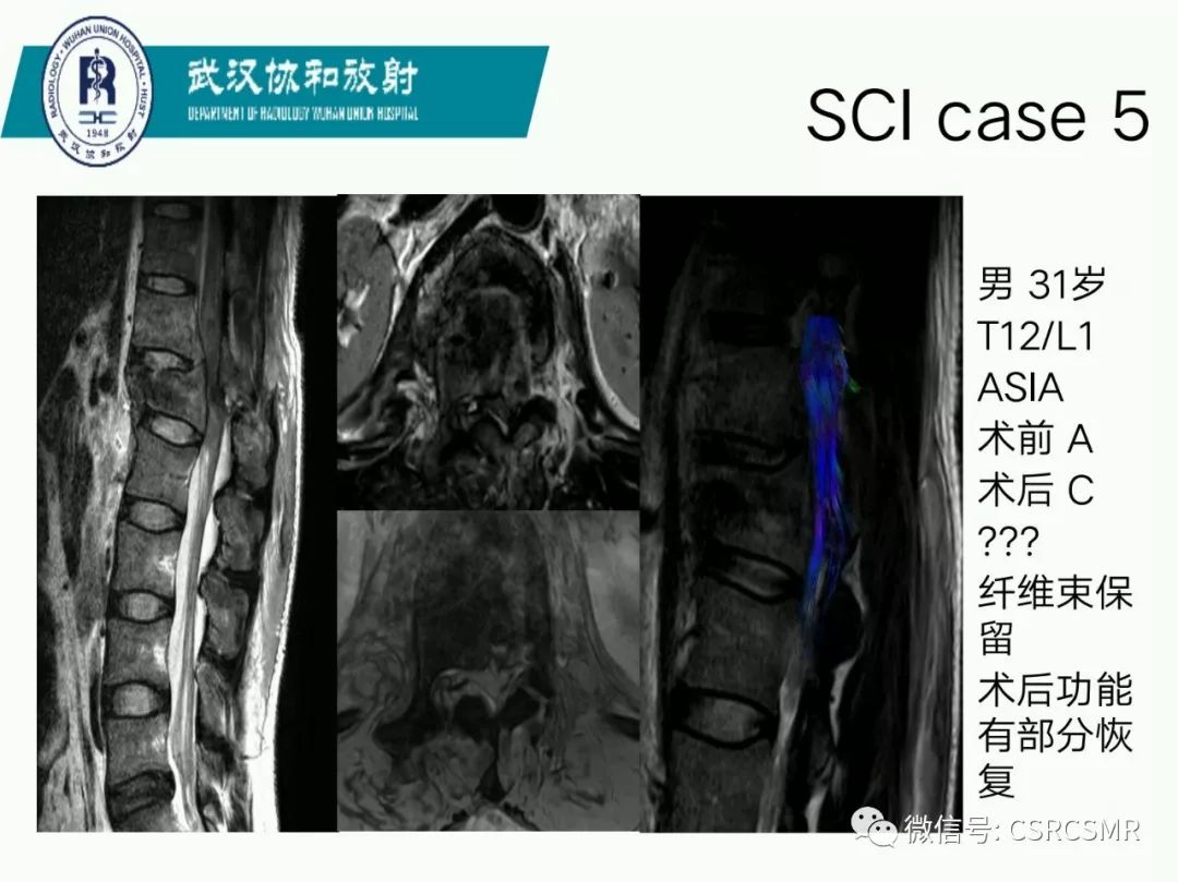 影像PPT - 【PPT】急性脊髓损伤--MR在临床决策和预后中的应用-26