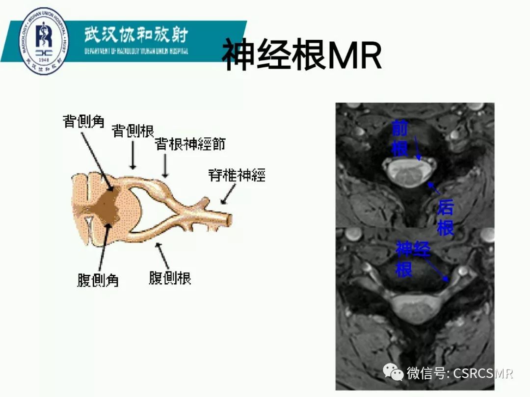 影像PPT - 【PPT】急性脊髓损伤--MR在临床决策和预后中的应用-35