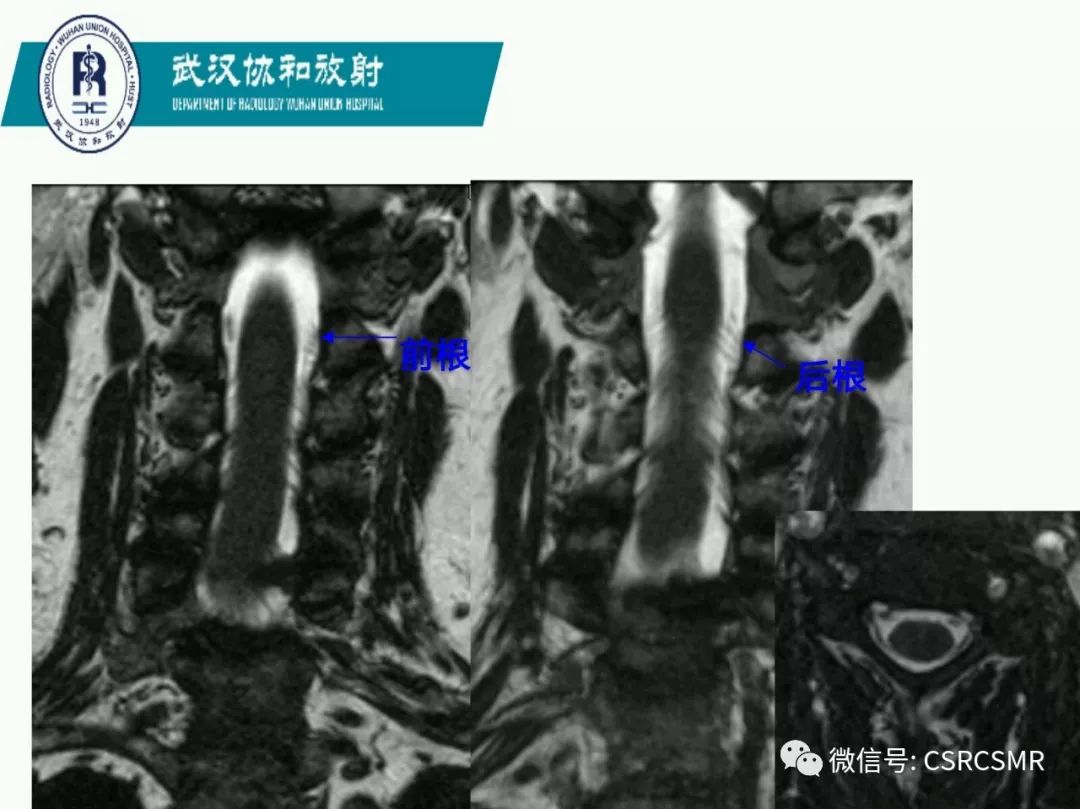 影像PPT - 【PPT】急性脊髓损伤--MR在临床决策和预后中的应用-36