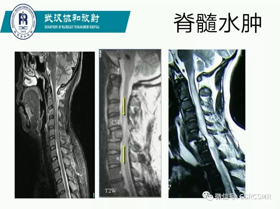 影像PPT - 【PPT】急性脊髓损伤--MR在临床决策和预后中的应用-41