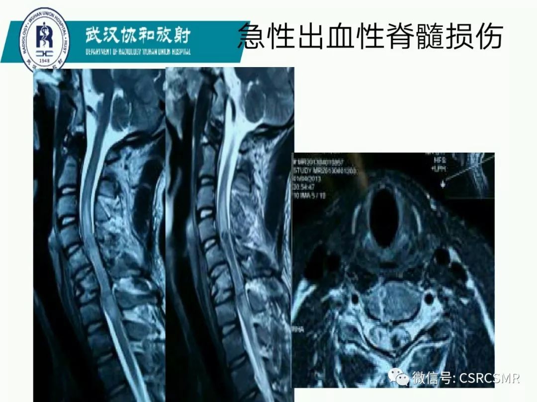 影像PPT - 【PPT】急性脊髓损伤--MR在临床决策和预后中的应用-42