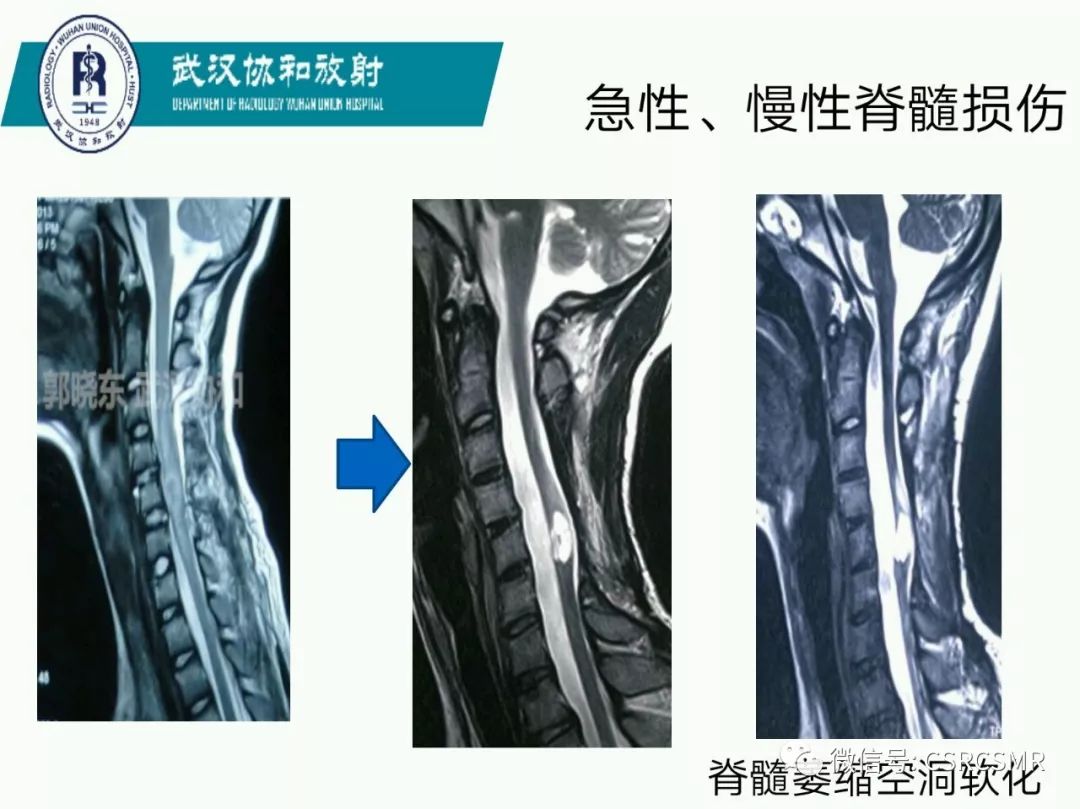 影像PPT - 【PPT】急性脊髓损伤--MR在临床决策和预后中的应用-44