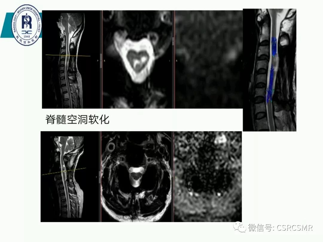 影像PPT - 【PPT】急性脊髓损伤--MR在临床决策和预后中的应用-45