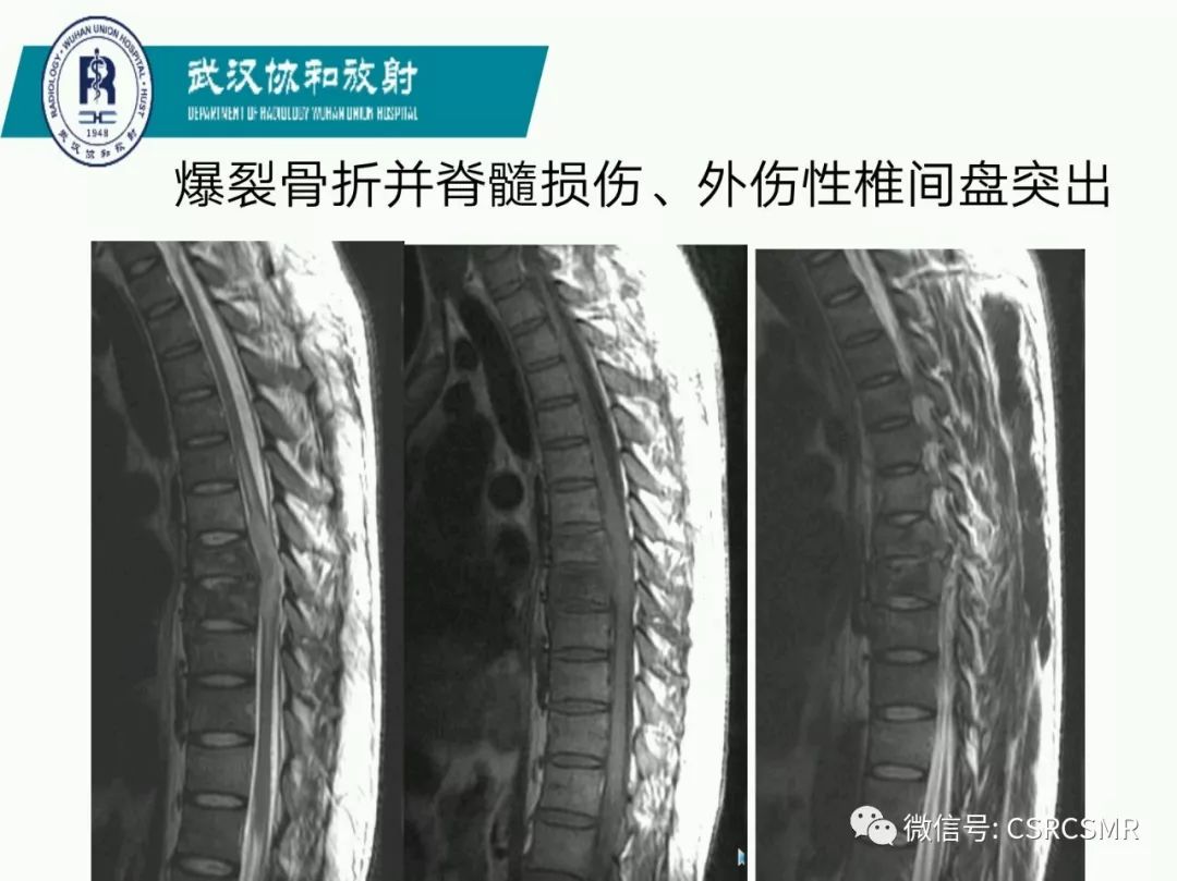 影像PPT - 【PPT】急性脊髓损伤--MR在临床决策和预后中的应用-47