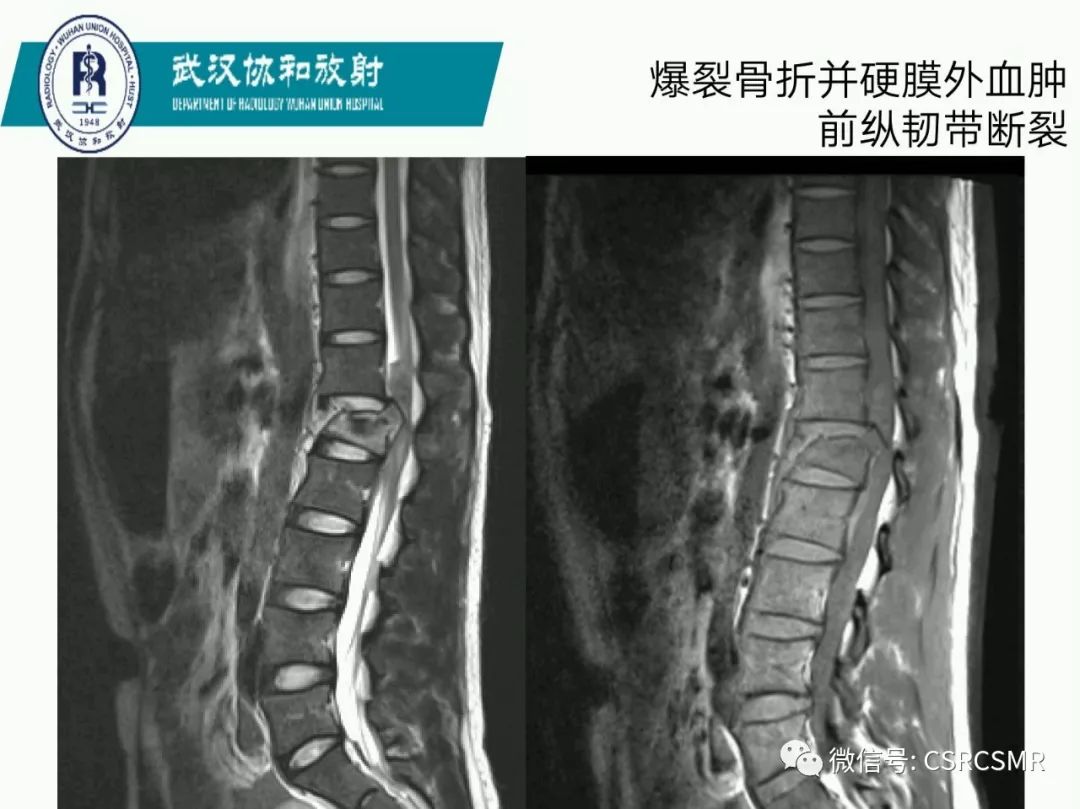 影像PPT - 【PPT】急性脊髓损伤--MR在临床决策和预后中的应用-49