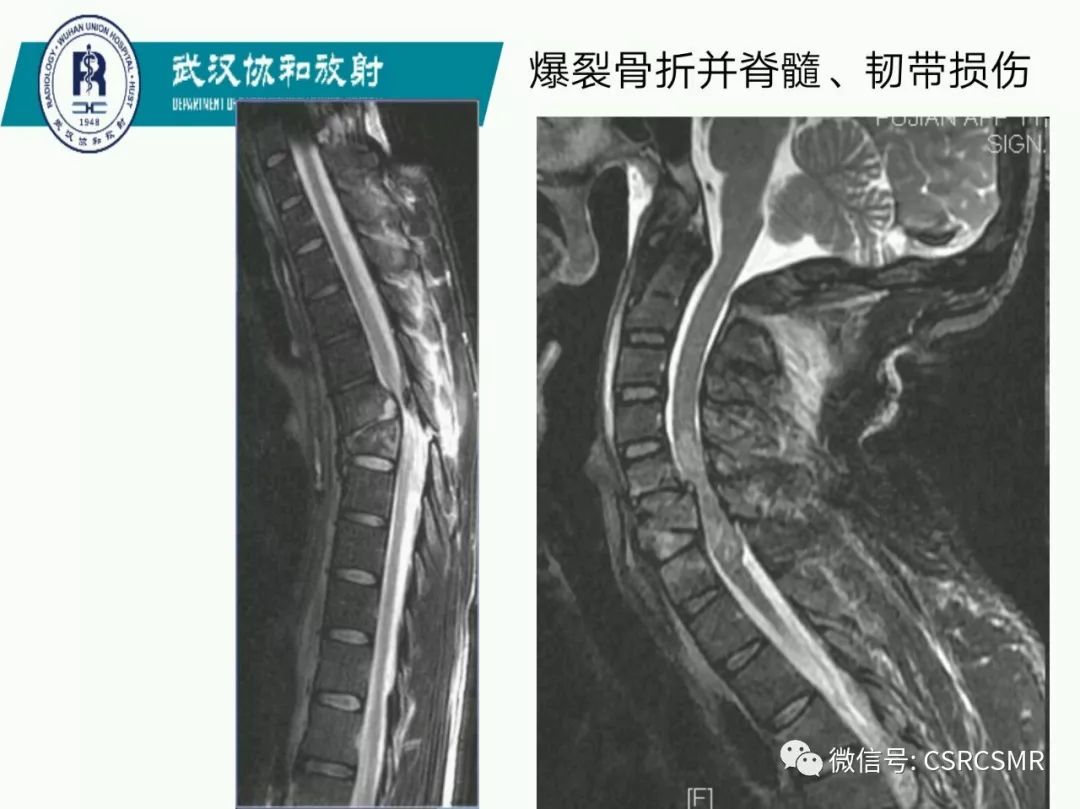 影像PPT - 【PPT】急性脊髓损伤--MR在临床决策和预后中的应用-50