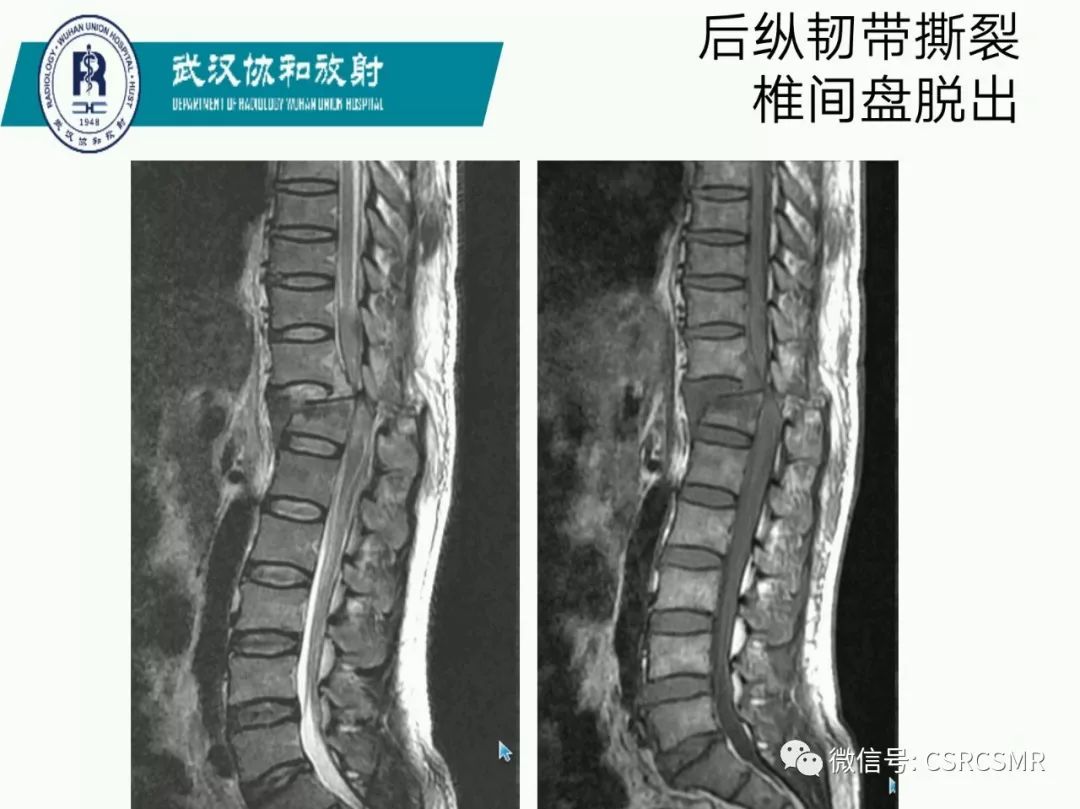 影像PPT - 【PPT】急性脊髓损伤--MR在临床决策和预后中的应用-51